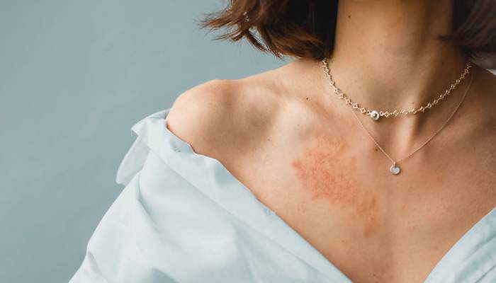 چگونه از حساسیت به طلا پیشگیری کنیم ؟